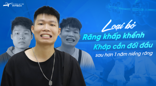 NIỀNG RĂNG QUYẾT ĐỊNH SÁNG SUỐT NHẤT TRONG 24 NĂM CUỘC ĐỜI MÌNH