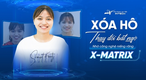 Mạnh mẽ đi niềng răng hô - khấp khểnh và cái kết