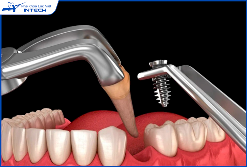 Giải đáp 21+ câu hỏi về cấy ghép Implant được thắc mắc nhiều nhất