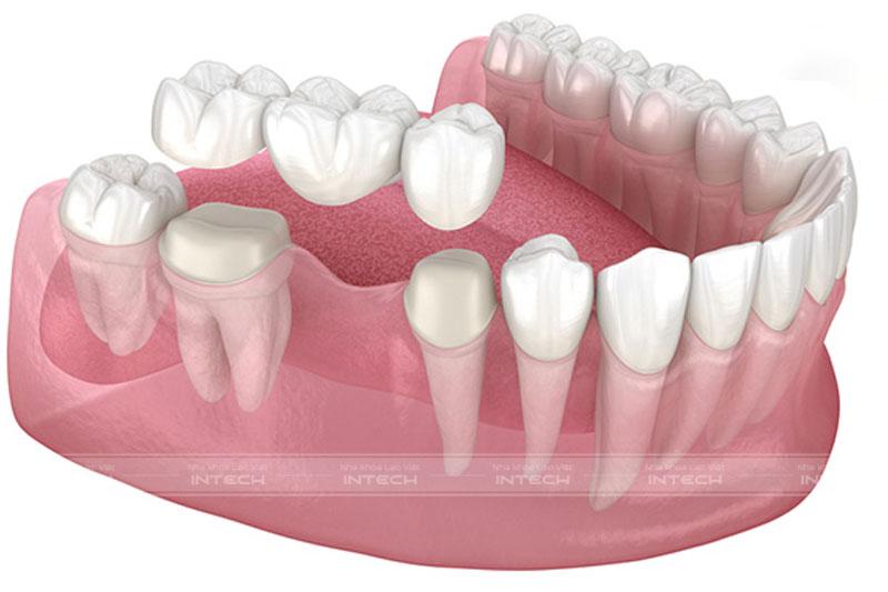 Làm cầu sứ phục hình răng số 6