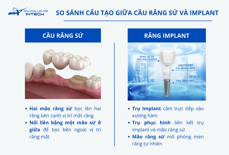 Cầu răng sứ và răng Implant có cấu tạo và mức độ ảnh hưởng các răng bên cạnh khác nhau