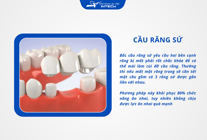 Cầu răng sứ yêu cầu mài 2 răng khỏe mạnh bên cạnh để làm trụ nâng đỡ cầu răng