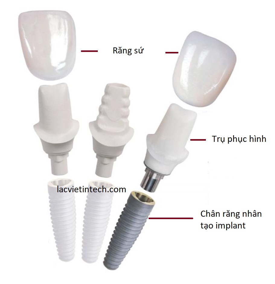 trồng răng implant cá nhân hóa DCT