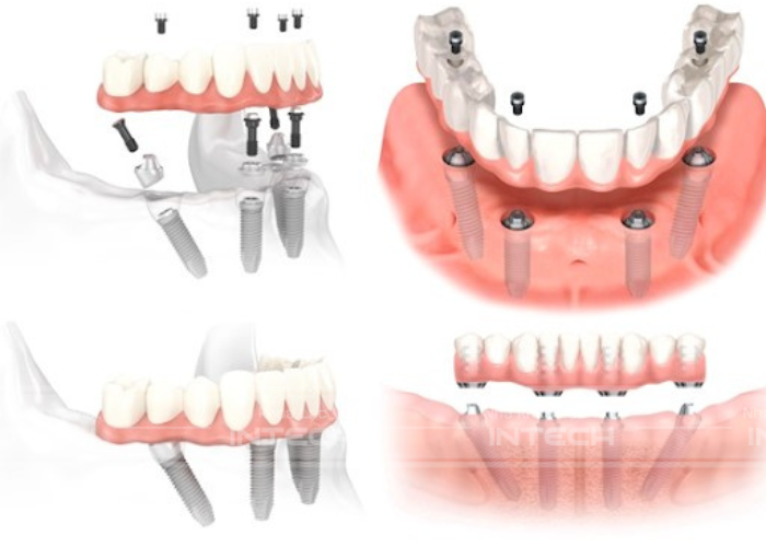 Cấy ghép implant All - On - 4 chỉ sử dụng 4 trụ giúp tiết kiệm chi phí