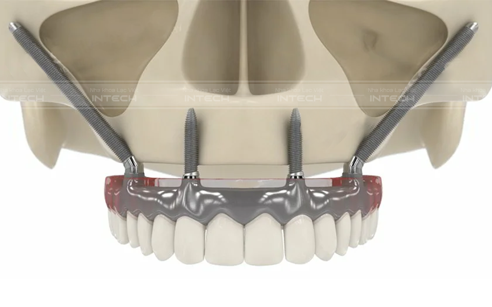 Cấy ghép implant xương gò má