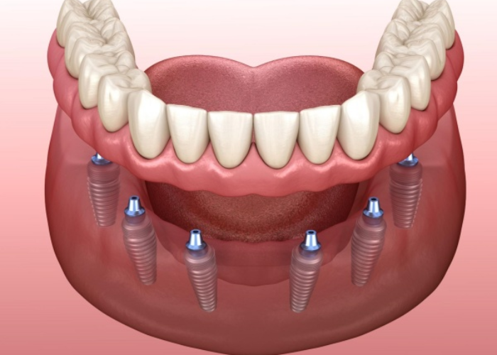 Cấy ghép implant All - On - 6 cần 6 trụ titanium