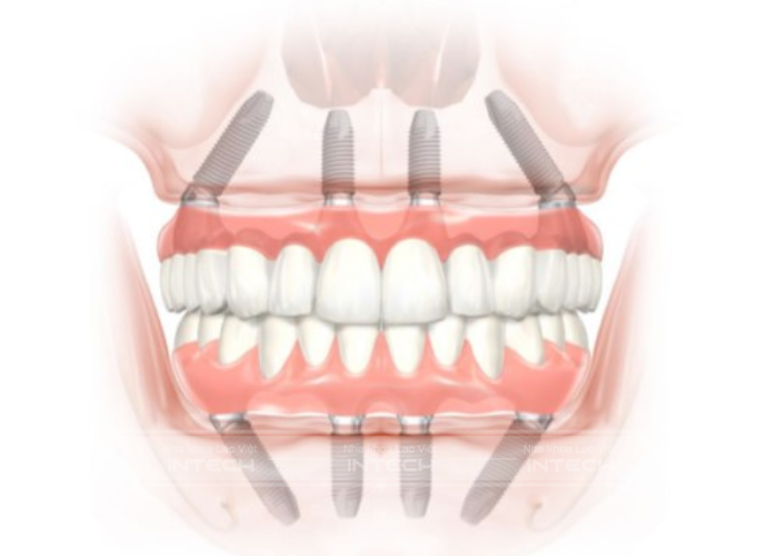 Cấy ghép implant All - On - 4 sử dụng 4 trụ titanium