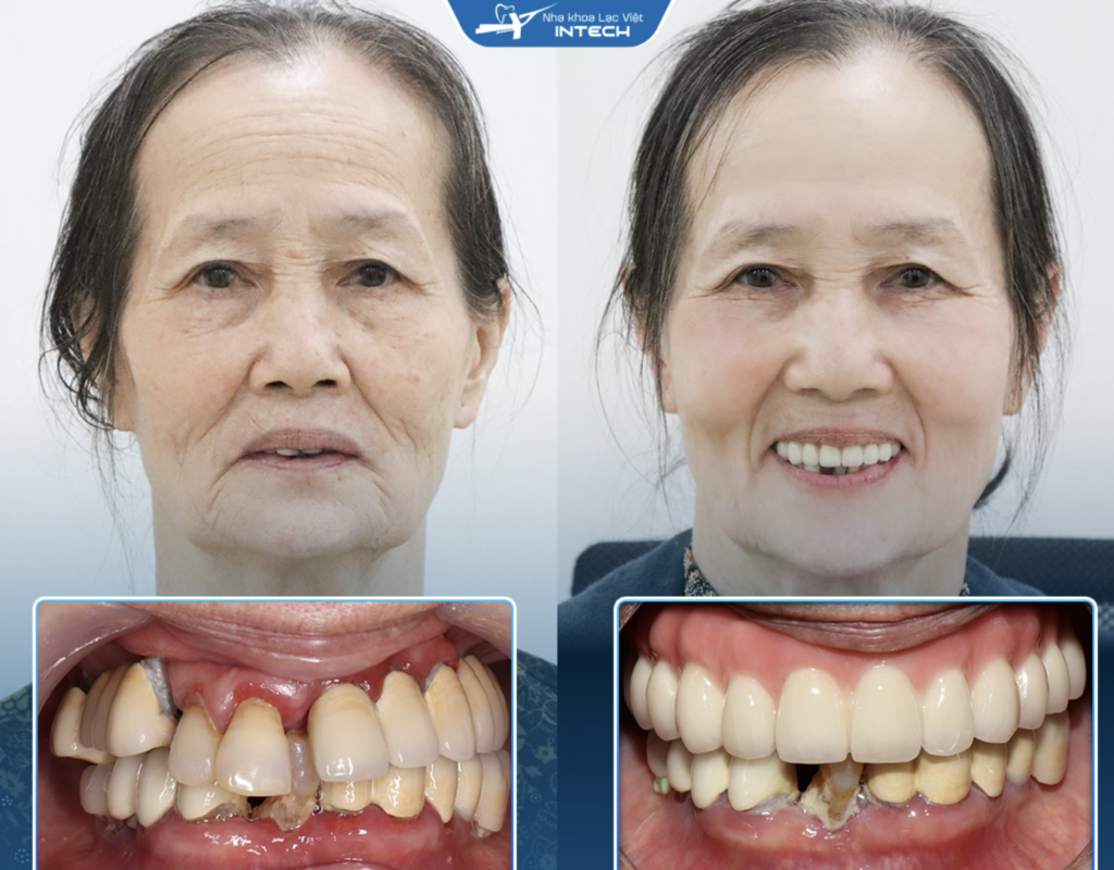 Cấy ghép implant phục hồi khả năng ăn nhai, thẩm mỹ
