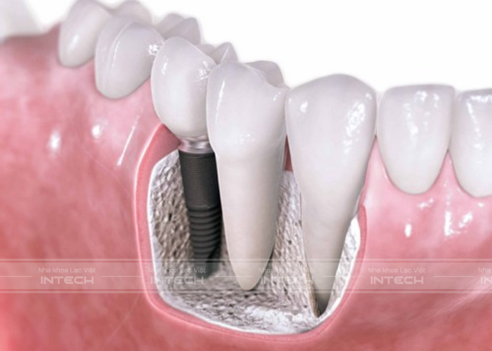 Cấy ghép implant ngăn ngừa tiêu xương hàm hiệu quả
