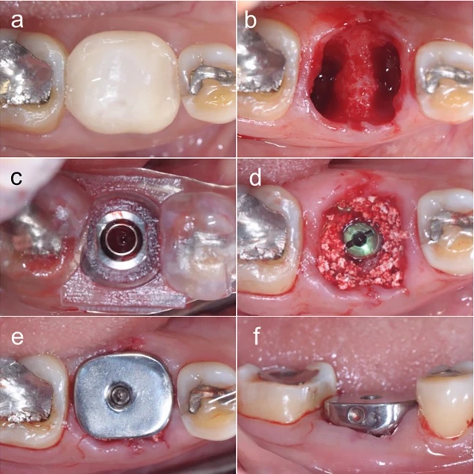 trồng răng implant cá nhân hóa