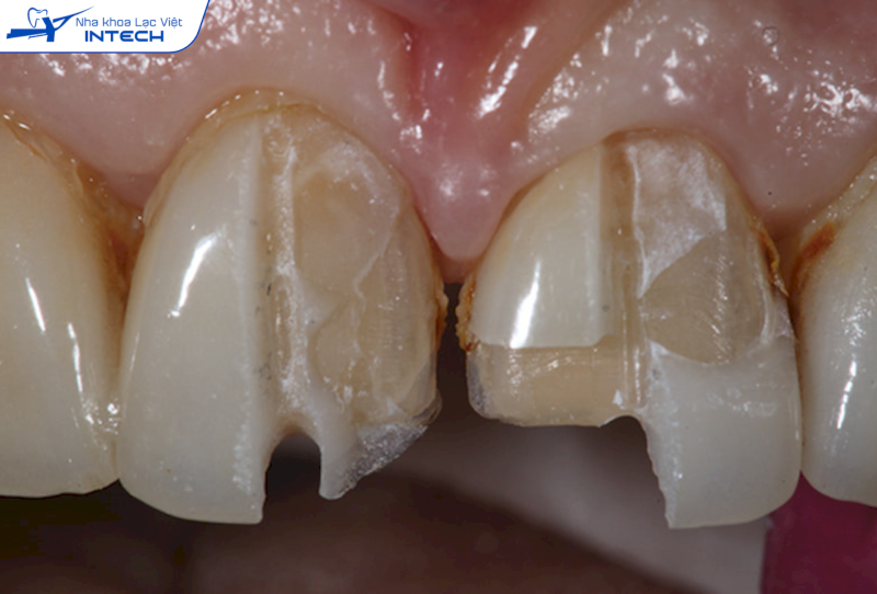 Bề mặt sứ Veneer cần chăm sóc kỹ vì vẫn có thể bể vỡ khi tác động lực mạnh