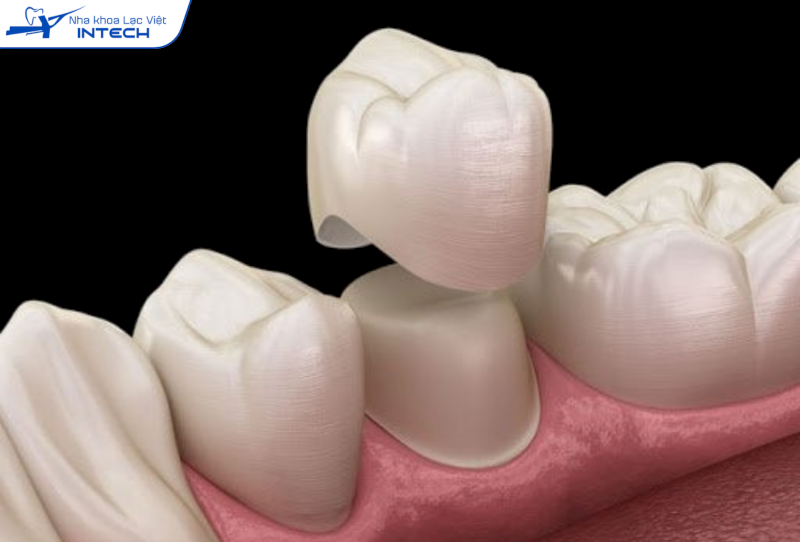 Bọc răng sứ có độ bền cao, màu sắc tự nhiên như răng thật