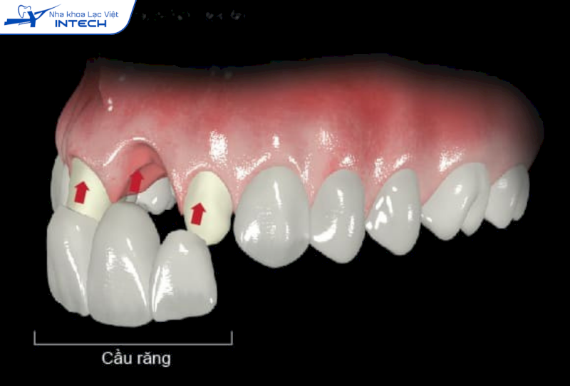 Cầu răng sứ răng khểnh sử dụng hai răng thật bên cạnh răng 3 làm trụ, nâng đỡ cho mão răng sứ ở giữa, lấp đầy khoảng trống bị mất răng
