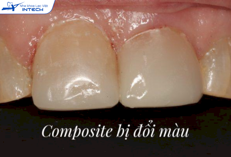 Composite có nhược điểm là nhanh đổi màu sau một thời gian sử dụng