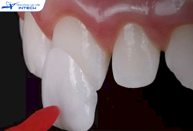 Dán sứ Veneer không cần mài răng, không gây ê buốt và có tính thẩm mỹ cao