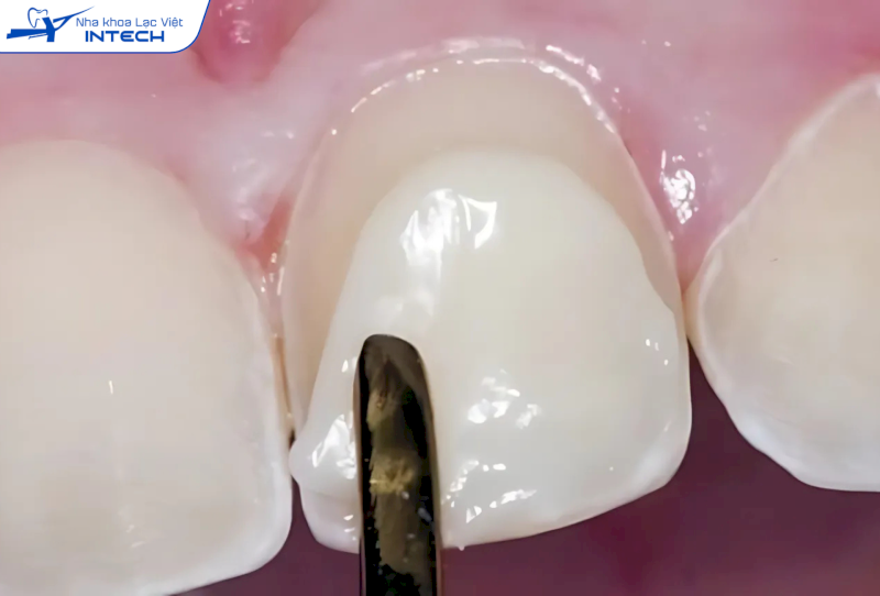 Đắp composite tạo răng khểnh không xâm lấn cấu trúc răng tự nhiên