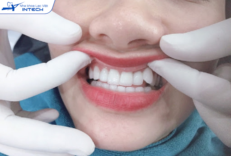 Phương pháp bọc răng sứ phải mài mòn răng thật bên trong, có thể dẫn đến ê buốt khi ăn uống