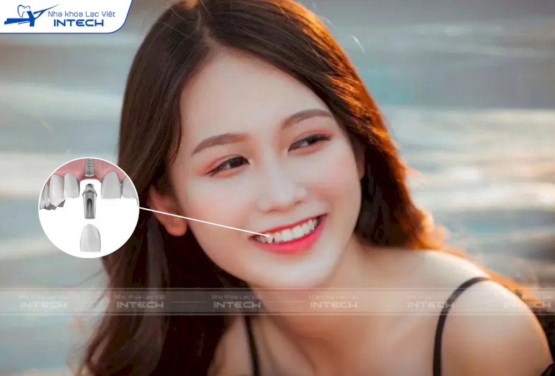 Cấy răng khểnh giá bao nhiêu? Gợi ý 3 phương bền, đẹp