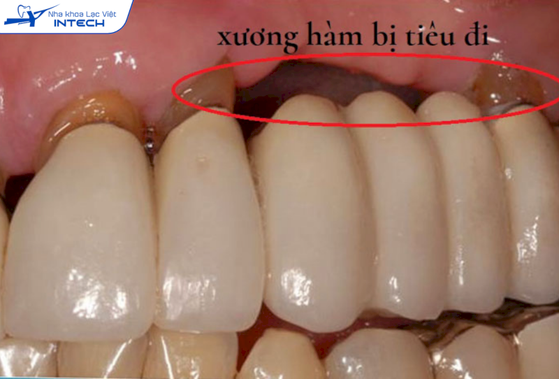 Về lâu dài, do không có chân răng thay thế, cầu răng sứ dễ xuất hiện tình trạng tiêu xương hàm, gây lộ khoảng đen mất thẩm mỹ