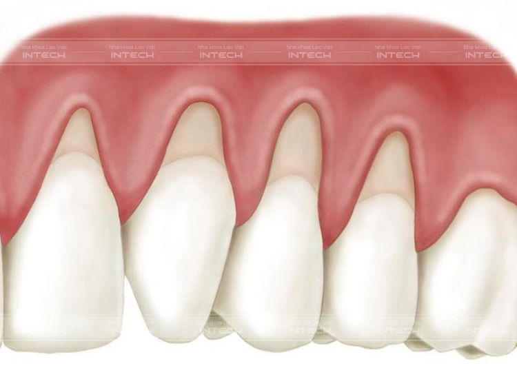 Chân răng bị tụt lợi