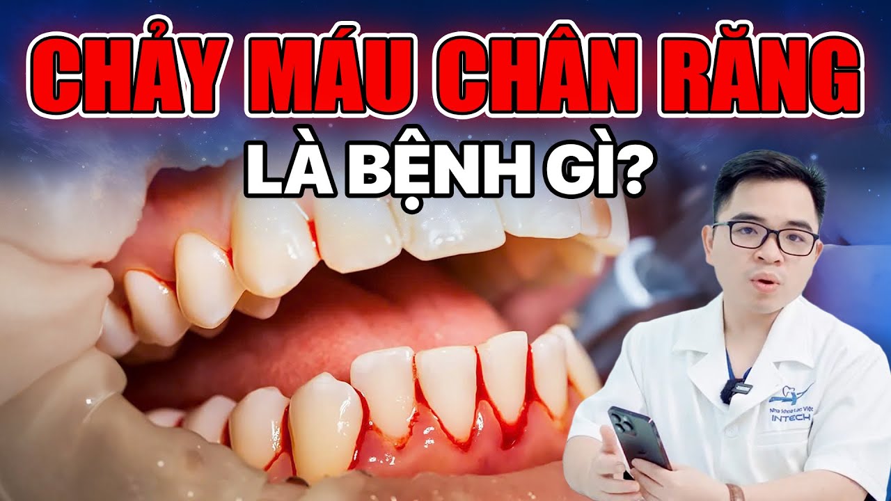 Chảy máu chân răng do đâu? 5 cách điều trị nhanh chóng và hiệu quả