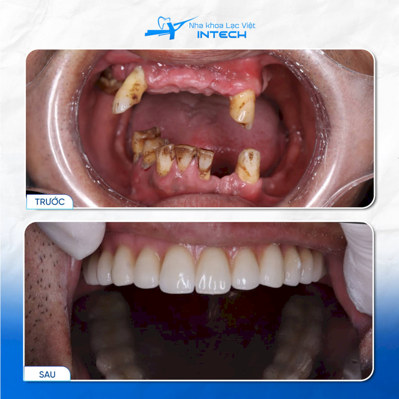 Chỉ định cấy ghép Implant - Ai nên và không nên thực hiện?