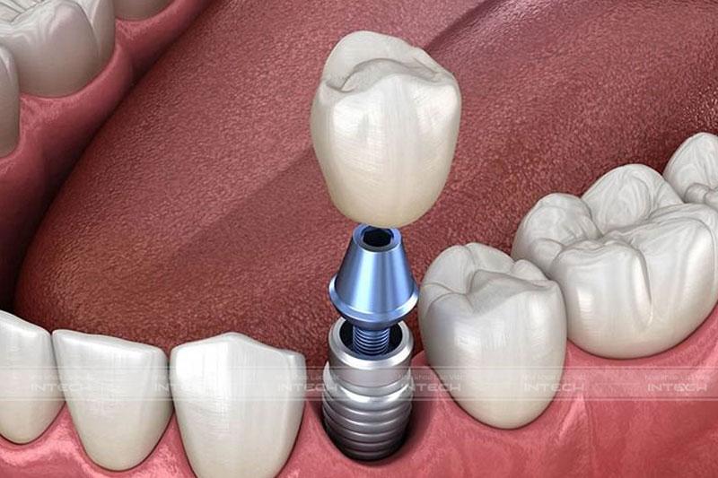 Chi phí răng sứ trên Implant là bao nhiêu?