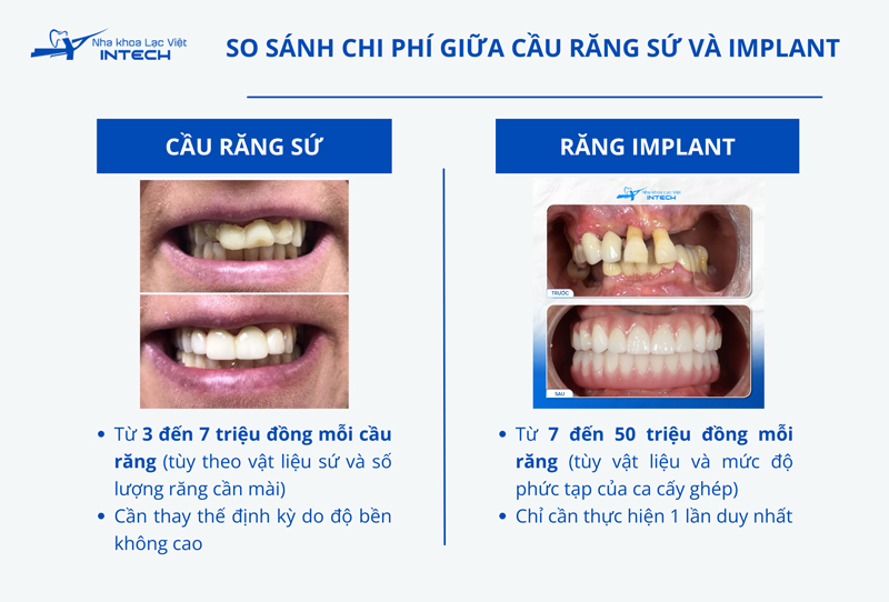 Chi phí thực hiện cấy ghép Implant cao hơn bắc cầu răng sứ, nhưng về lâu dài, do không cần thay thế định kỳ nên sẽ tiết kiệm hơn