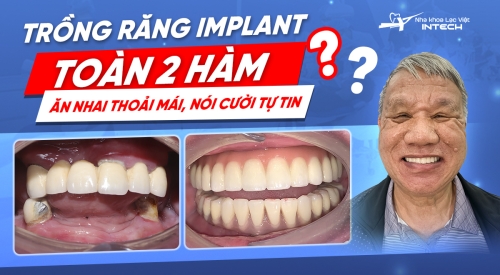 TRỒNG RĂNG IMPLANT TOÀN 2 HÀM - ĂN UỐNG THOẢI MÁI, CƯỜI NÓI TỰ TIN 