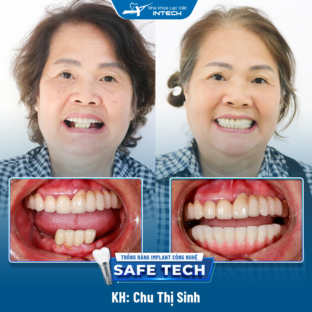 Cô Chu Thị Sinh trồng răng toàn hàm dưới tại Lạc Việt Intech