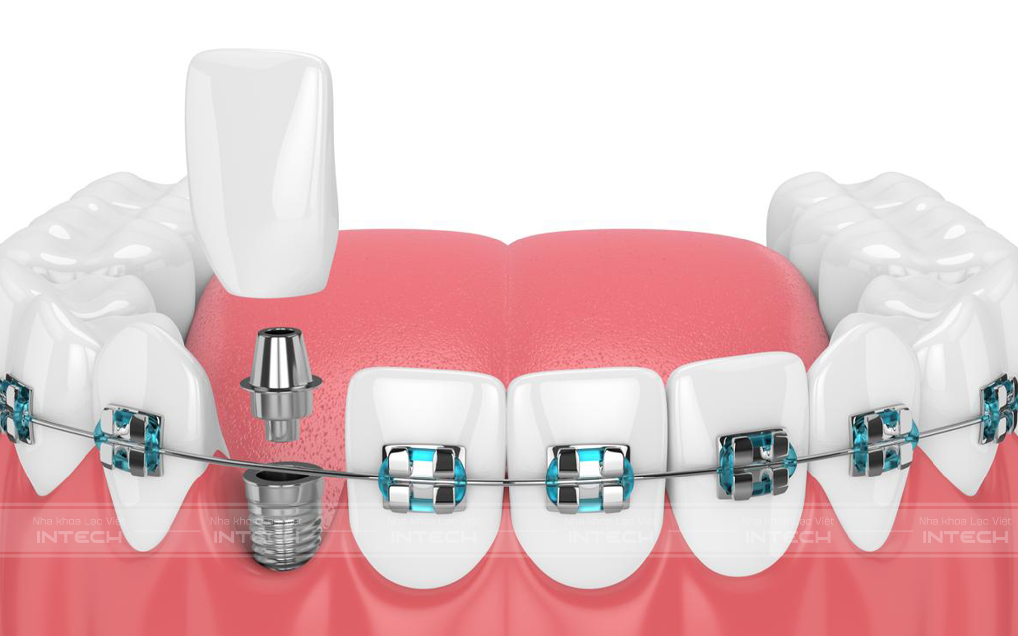Có thể niềng răng sau khi cấy ghép implant