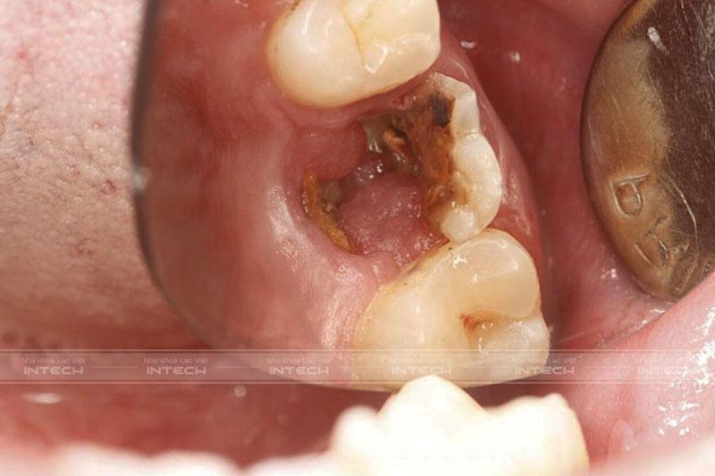 Còn chân răng vẫn sẽ xảy ra tình trạng tiêu xương hàm