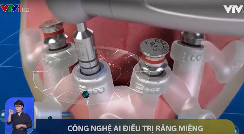 Công nghệ trí tuệ nhân tạo giúp xác định vị trí cấy ghép Implant