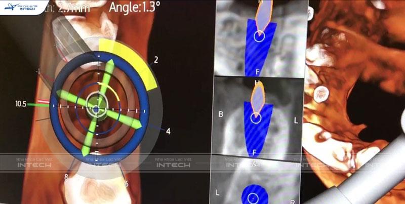 Công nghệ trồng răng Implant Safe Tech