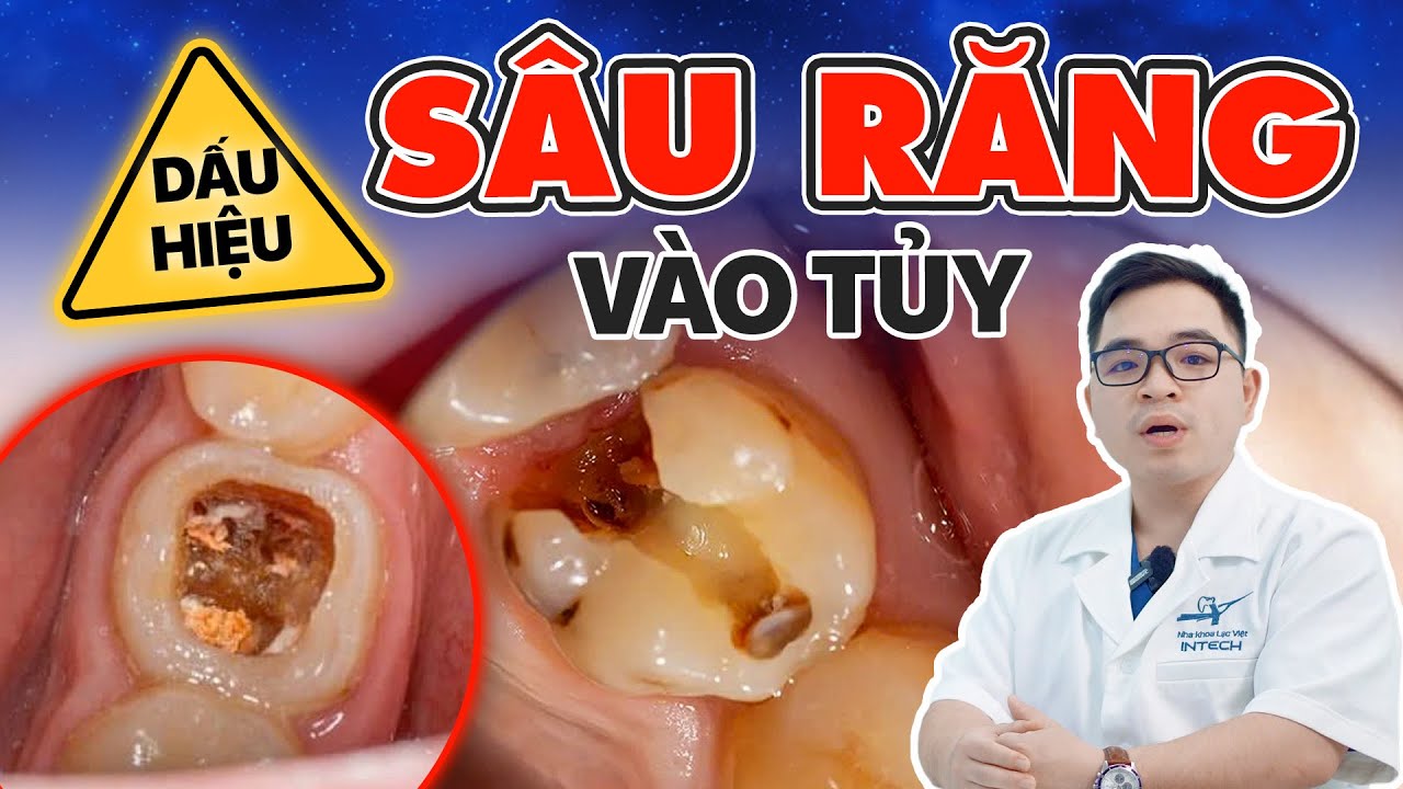 4 dấu hiệu sâu răng vào tuỷ và các cách điều trị dứt điểm