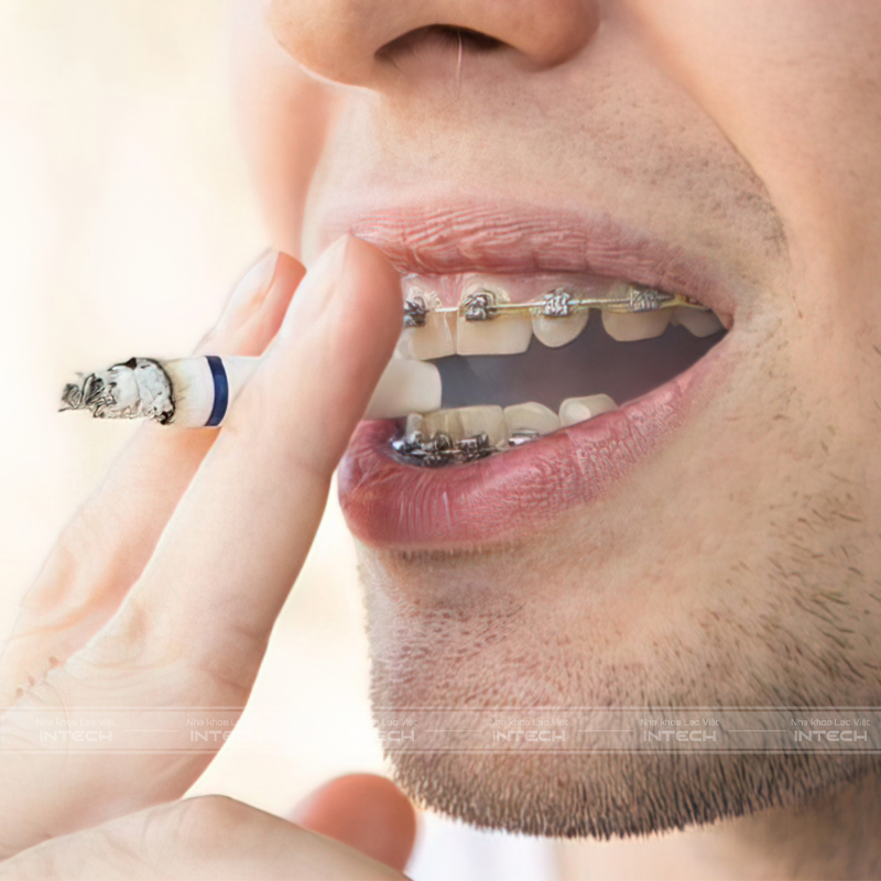 Hút thuốc lá là nguyên nhân chính khiến dây chun bị ố vàng khi niềng răng