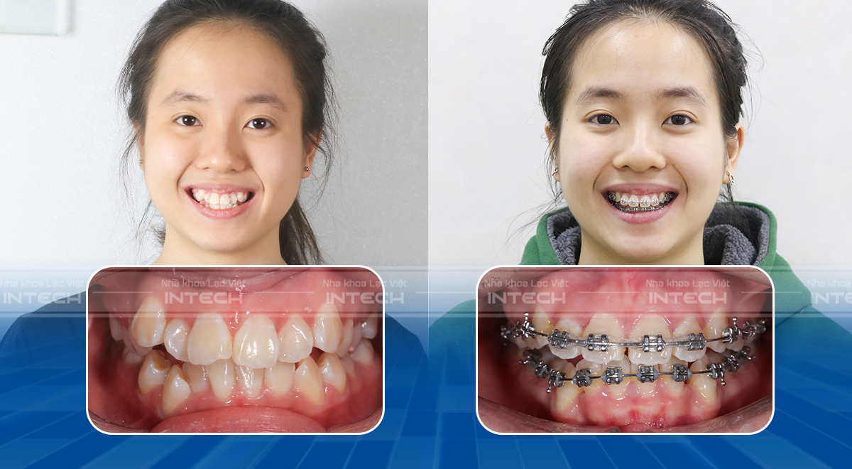 Khách hàng được chỉ định dùng thun chuỗi để kéo đóng khoảng khe thưa vùng răng cửa