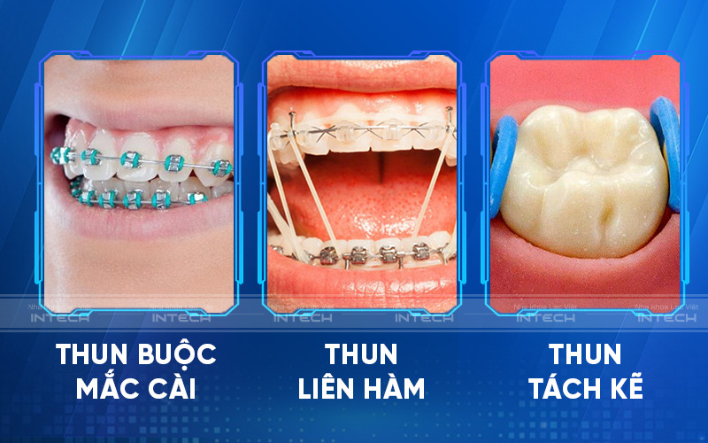 Một số loại chun chỉnh nha được các bác sĩ sử dụng phổ biến