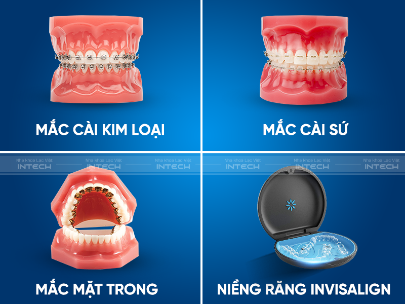 Đa dạng các phương pháp niềng răng tại Vinh giúp khách hàng có nhiều lựa chọn