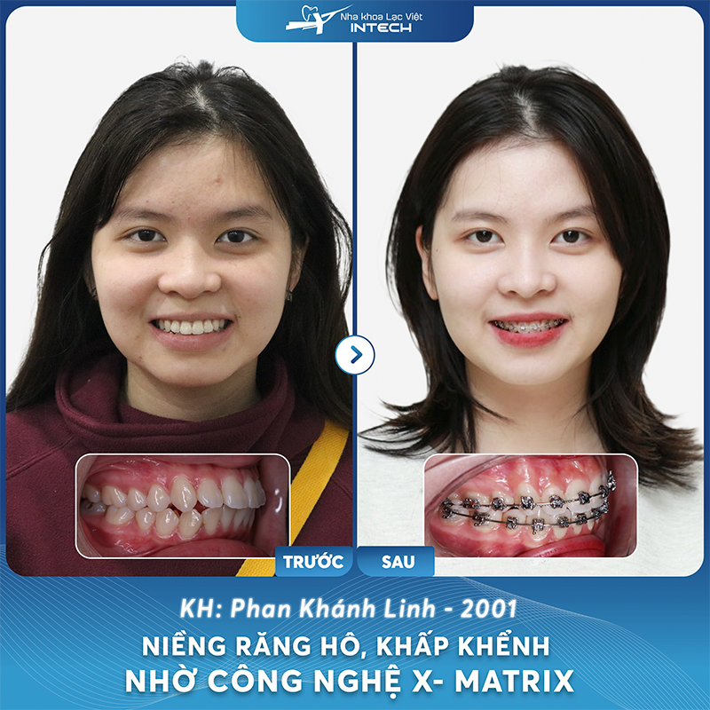 Niềng răng mắc cài tự động mang đến hiệu quả chỉnh nha tối ưu