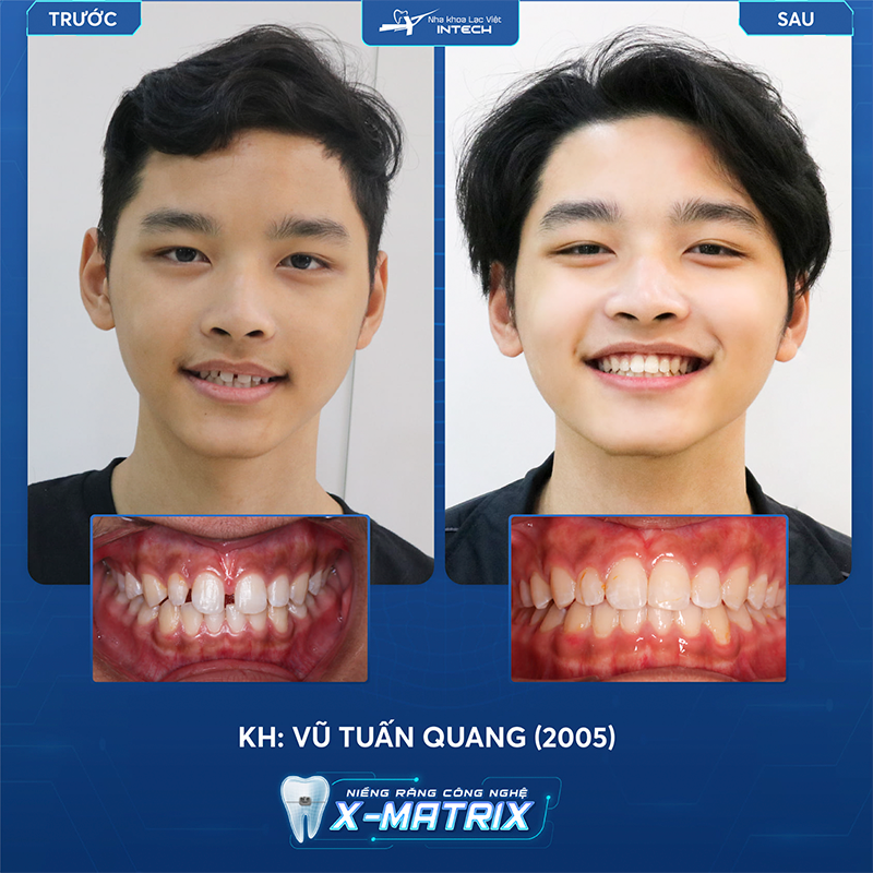 Khách hàng Vũ Tuấn Quang niềng răng công nghể X - Matrix