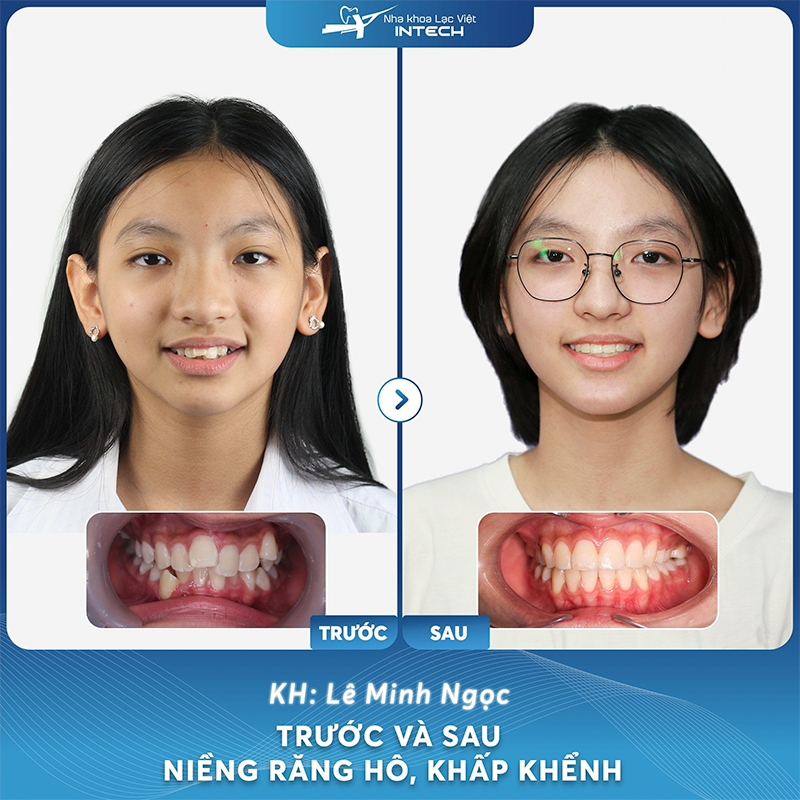Khách hàng Lê Minh Ngọc trước và sau niềng răng hô, khấp khểnh