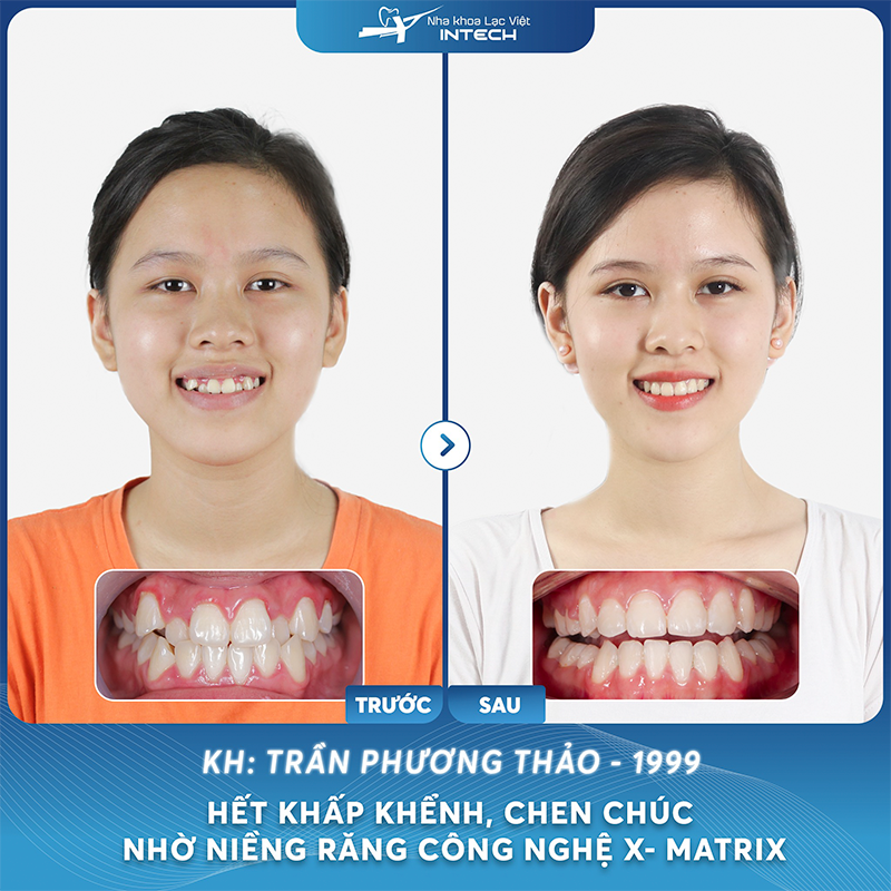 Khách hàng Trần Phương Thảo hết khấp khểnh, chen chúc nhờ niềng răng công nghệ X - Matrix