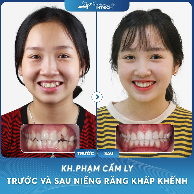 Khách hàng Phạm Cẩm Ly trước và sau niềng răng khấp khểnh
