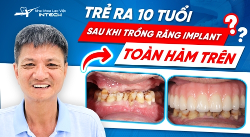 Cuộc sống trở nên ý nghĩa hơn kể từ khi trồng răng toàn hàm trên
