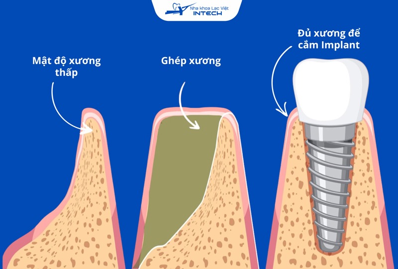 Ghép xương được chỉ định cho người có xương hàm không đủ để cắm Implant