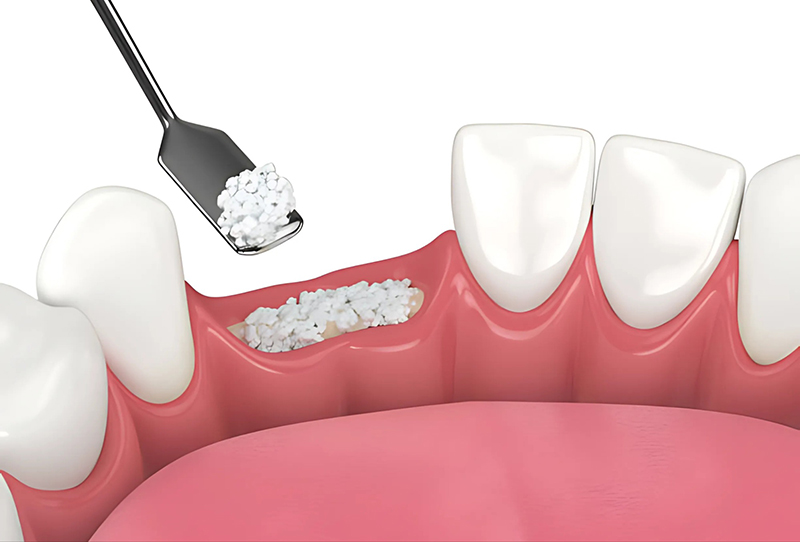 Ghép xương là một thủ thuật bổ sung xương khi xương hàm không đủ thể tích để cắm Implant