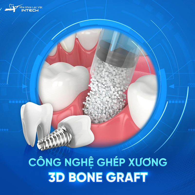 Nếu đảm bảo đủ các yếu tố về vật liệu, kỹ thuật và môi trường ghép xương thì tỷ lệ thành công có thể lên tới hơn 90%