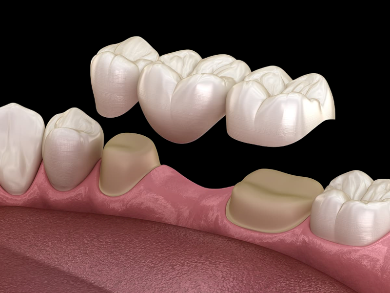 Bắc cầu răng sứ có chi phí rẻ hơn trồng răng Implant, tuy nhiên không đảm bảo tuổi thọ lâu dài