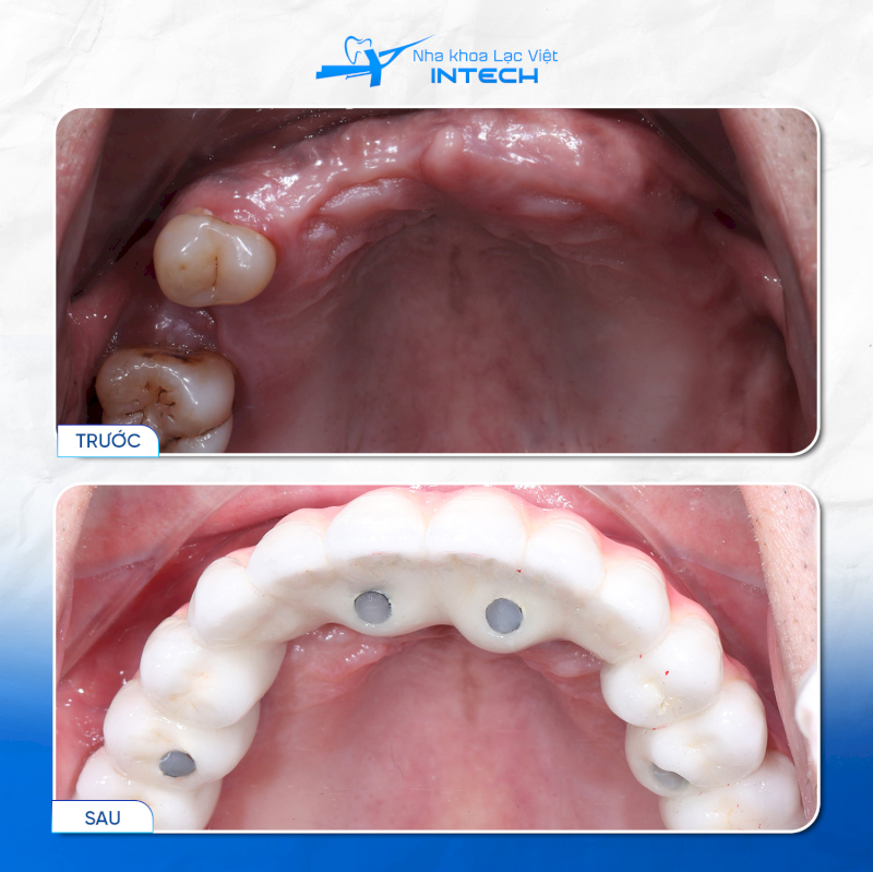 Giải pháp phục hình răng hàm bằng cấy ghép Implant mang lại kết quả ổn định, lâu dài